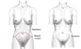 Abdominoplastie