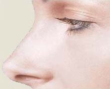 Rhinoplastie