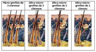 Micro greffes de cheveux